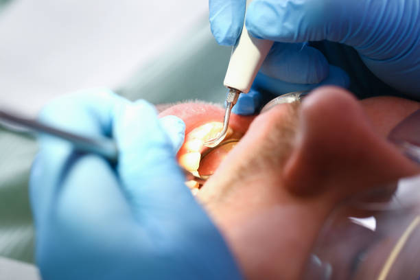 Best Emergency Wisdom Teeth Removal in Glenville, CT